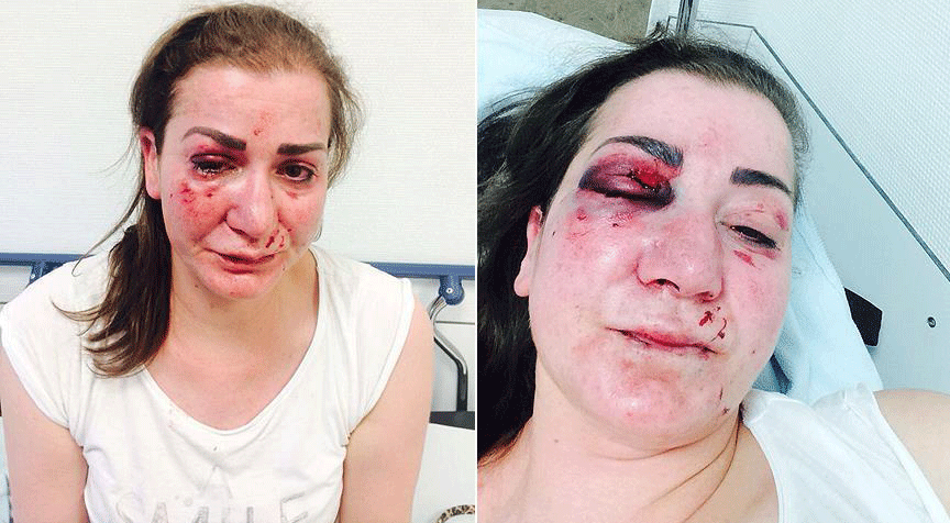 Envoy visits Turkish woman who was attacked in Germany