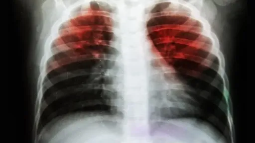 Funding gaps risk undoing progress on TB, still killing 1.2 million yearly: WHO