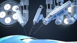Robotic brain tumor surgery successfully performed for the first time in Dedeağaç